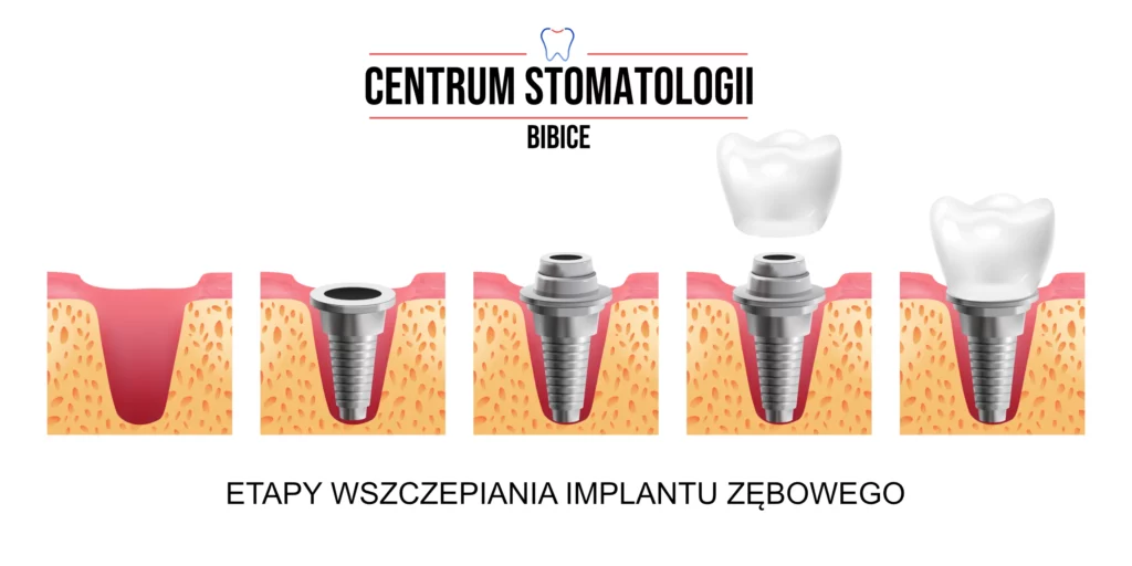 implanty zębów etapy