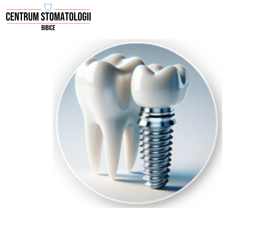 Implanty zębów – co warto wiedzieć przed podjęciem decyzji